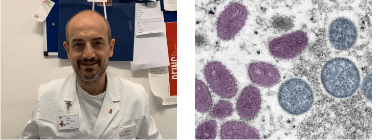 Prof. Di Biagio.- Es necesario Informarse, reconocer los síntomas, prevenir y que hacer en caso de contagio de la Viruela del&nbsp;Mono.